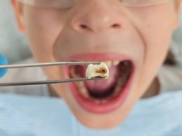 Best Emergency Dentist for Lost Fillings or Crowns in Bartlett, TX